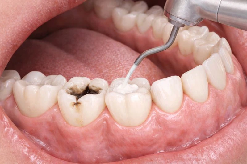 Dental Emergencies: What to Do in the First 60 Minutes of an emergency and minimize damage