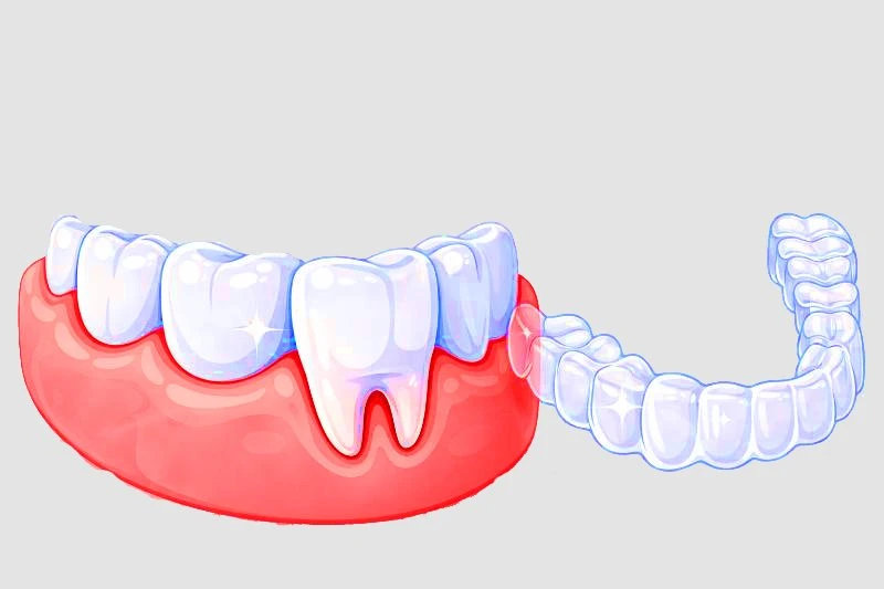 Clear Aligners