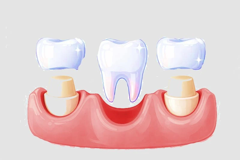 Dental Bridges