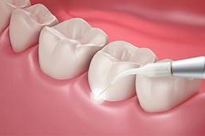 Dental Lasers