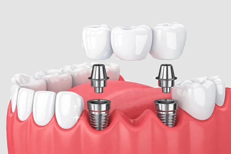 Dental Implants